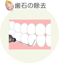 歯石の除去